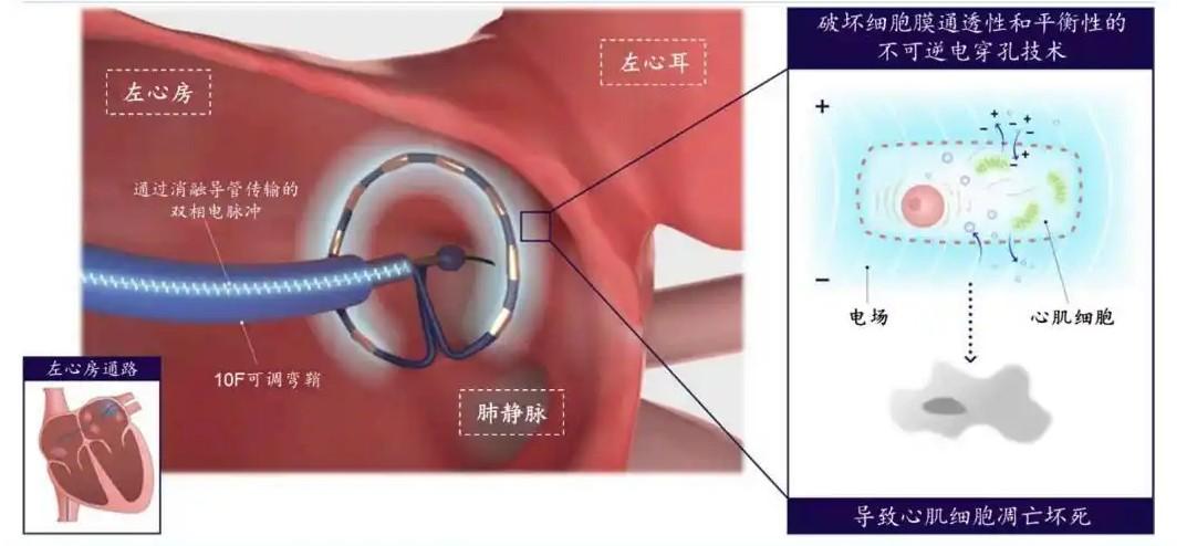 房颤怎么治疗最好