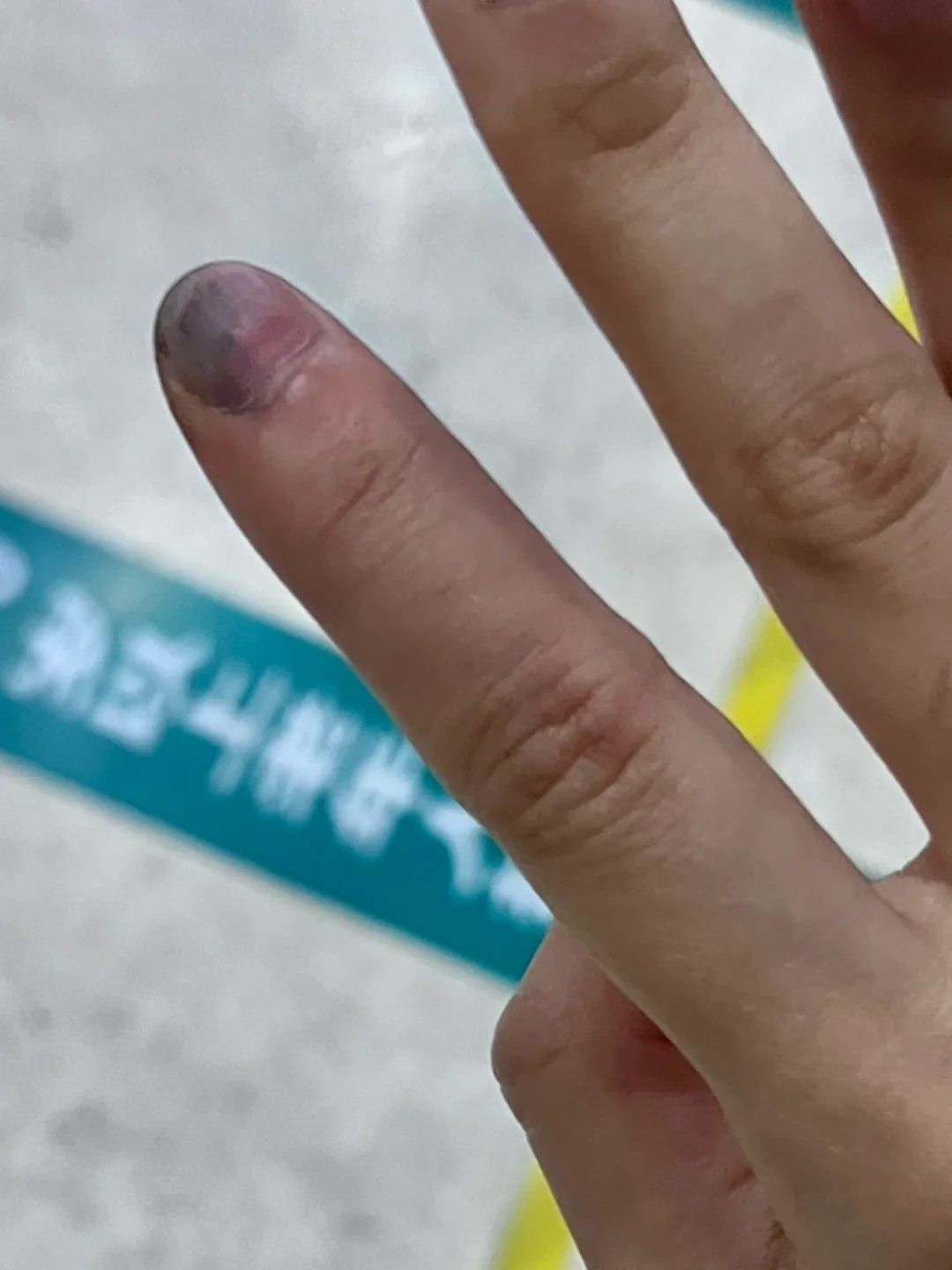 手指被门夹了,怎么办?