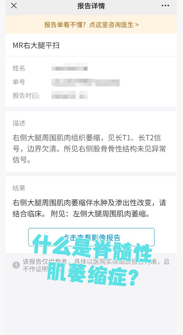 脊髓性肌萎缩症该怎么治疗