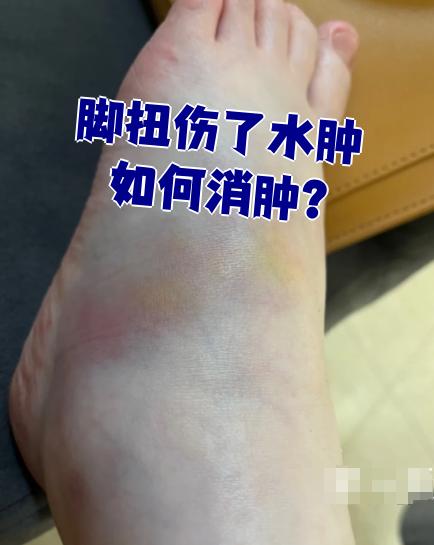 脚崴了肿了怎么消肿?