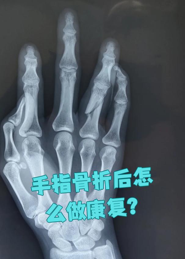 手指骨折康复怎样训练多久能好