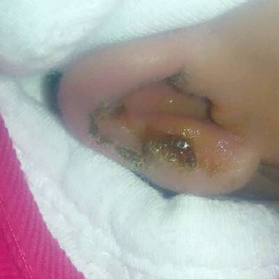 耳朵流水怎么回事