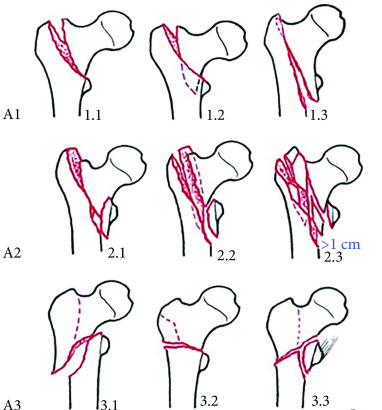 股骨粗隆间骨折分型