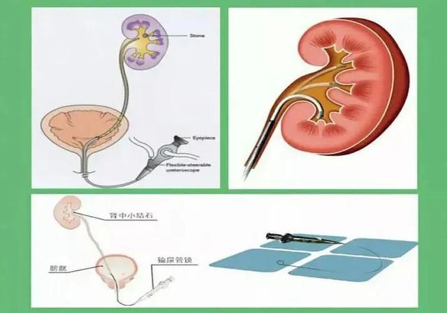 什么是输尿管镜碎石取石术