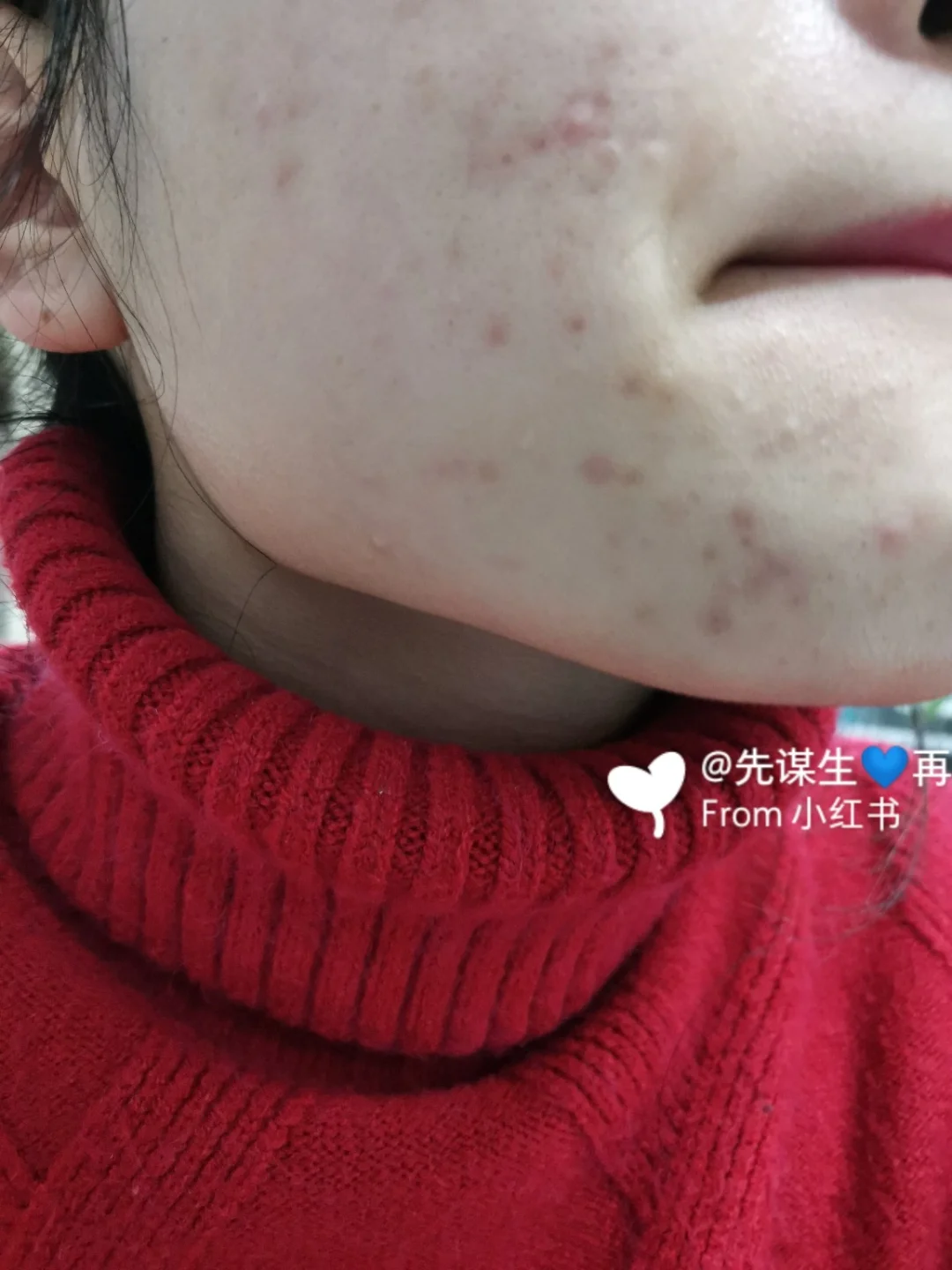 红色痘印怎么消除