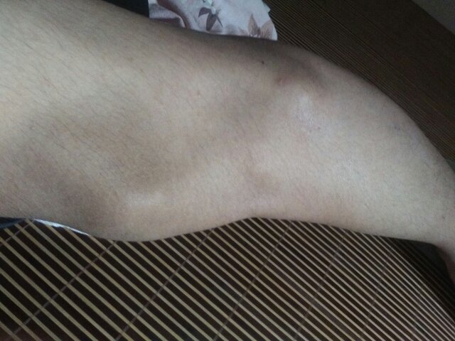 膝盖下边有突出来的骨头