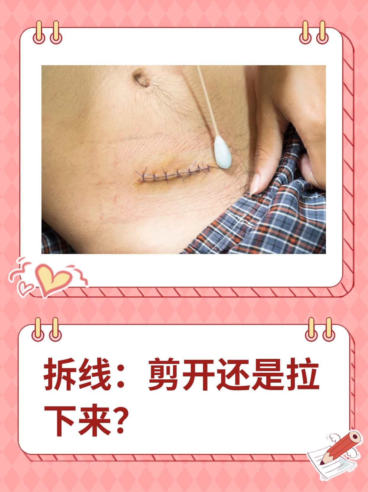 拆线疼不疼