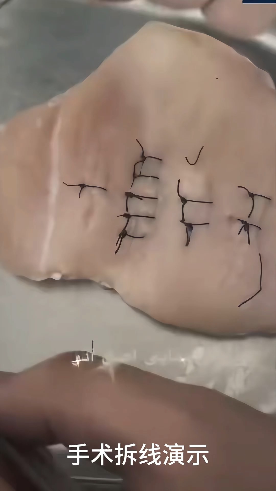 拆线疼不疼