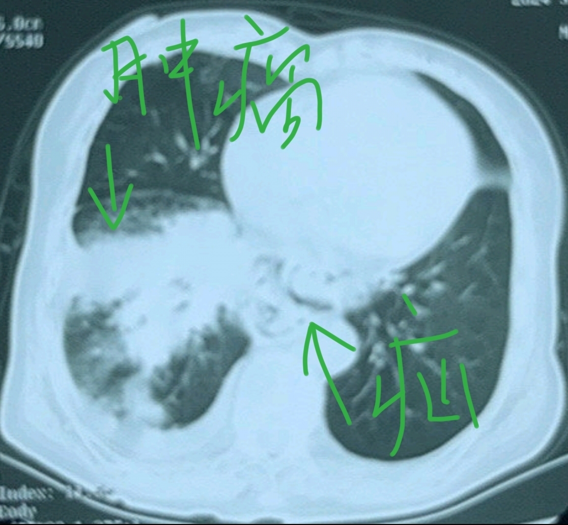 肺部CT能检查出肺癌吗