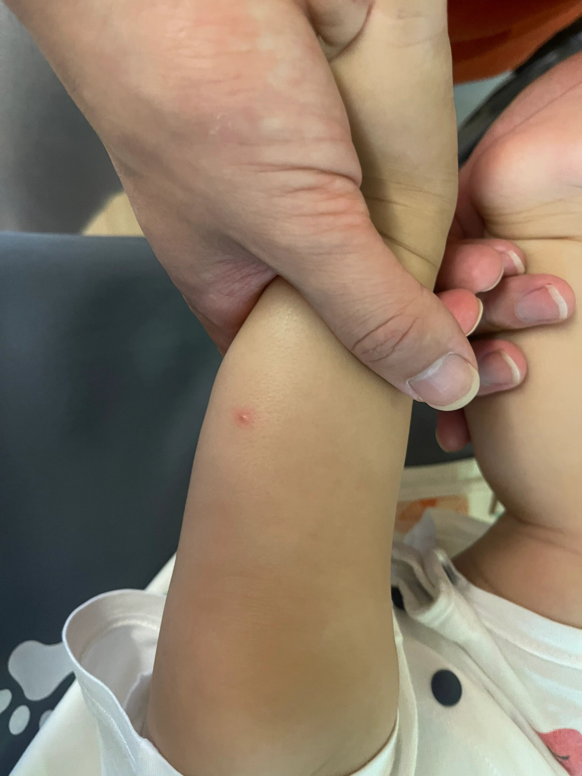 小孩身上起红点像痱子一样