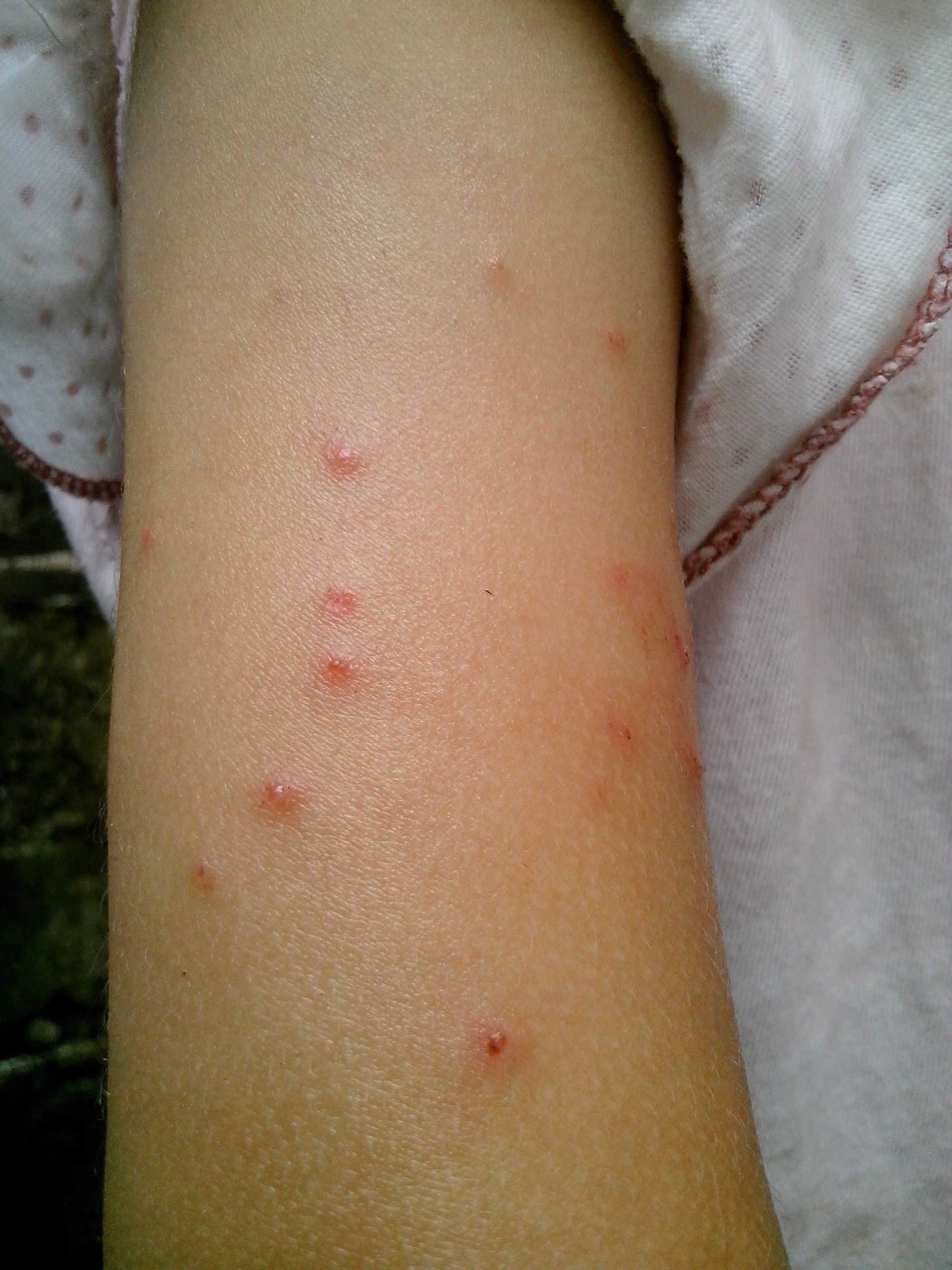 小孩身上起红点像痱子一样