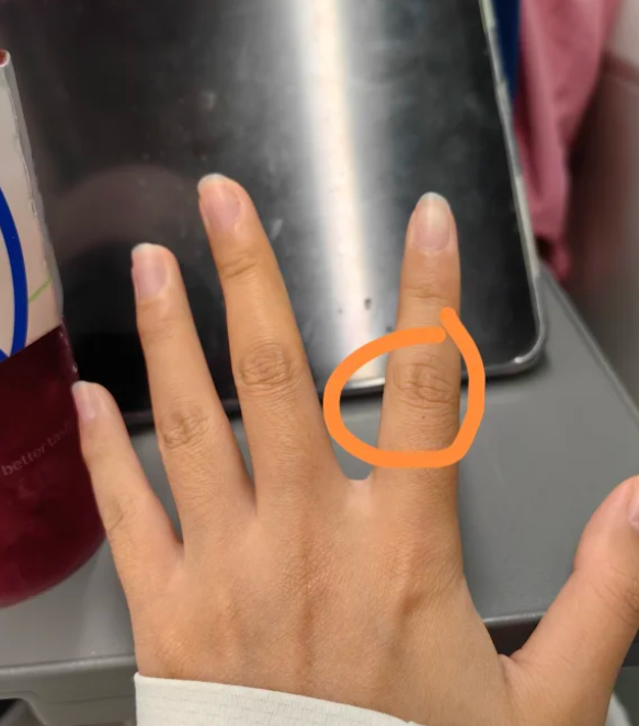 手指肚疼像针扎,是什么原因