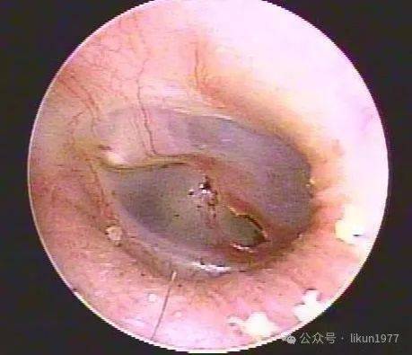 分泌性中耳炎能自愈吗?
