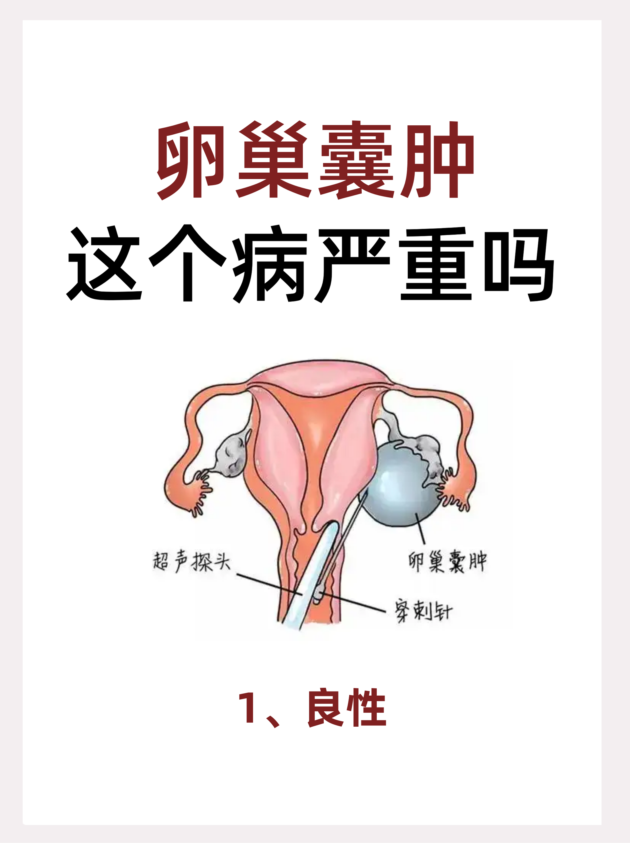 妇科囊肿怎么治疗