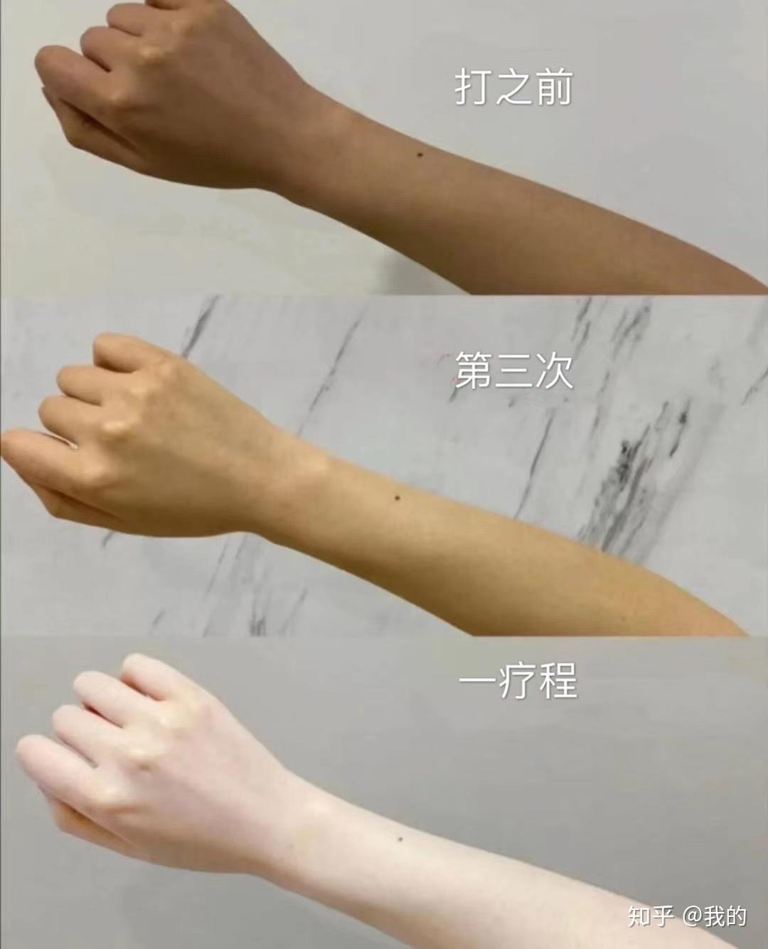 打美白针能维持多久?