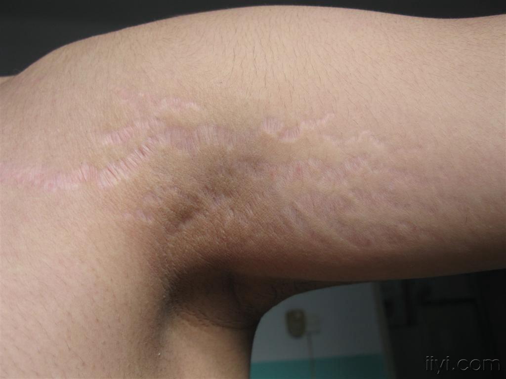 皮肤萎缩怎么回事