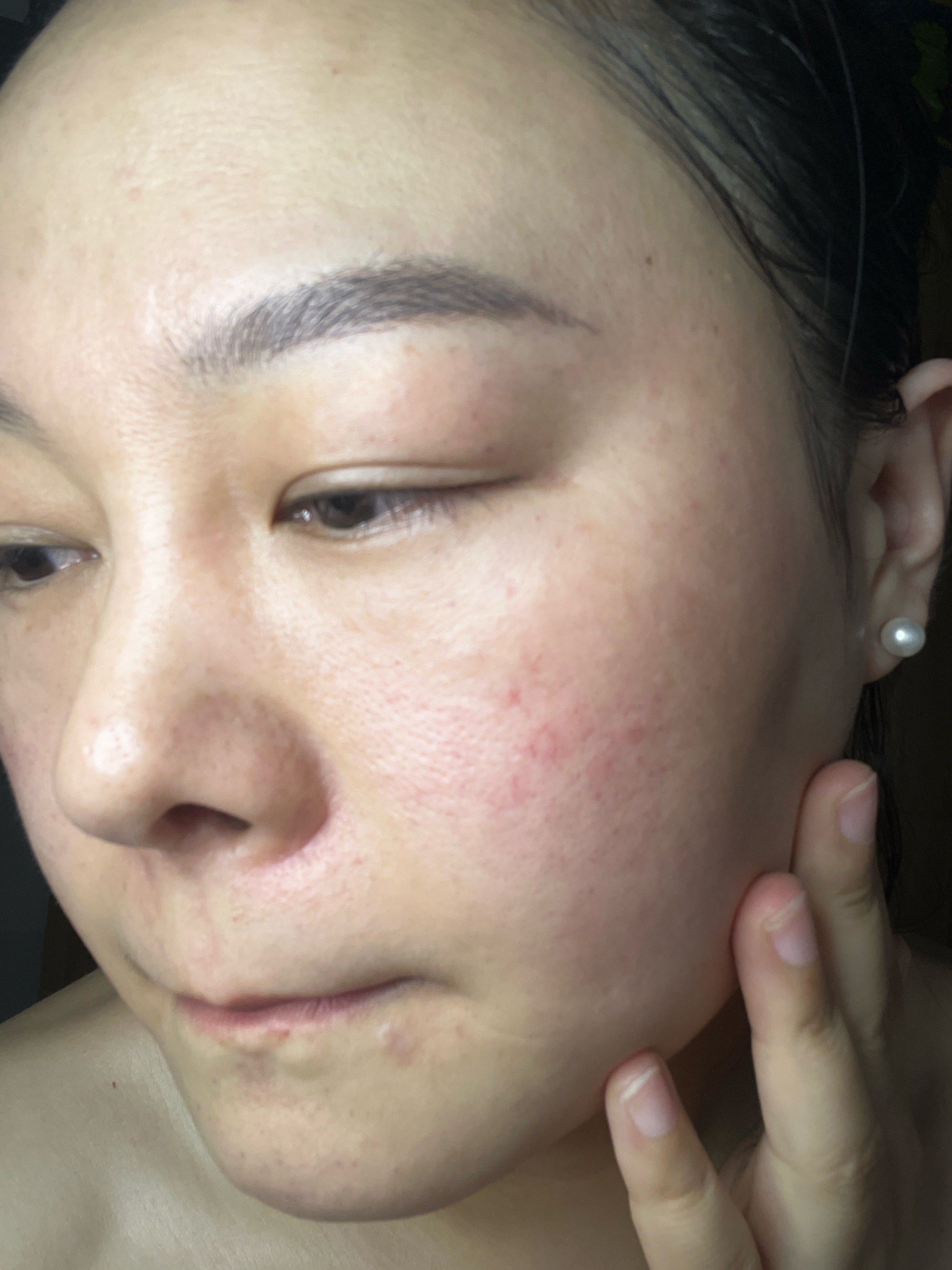 脸上脸颊长小红点是怎么回事