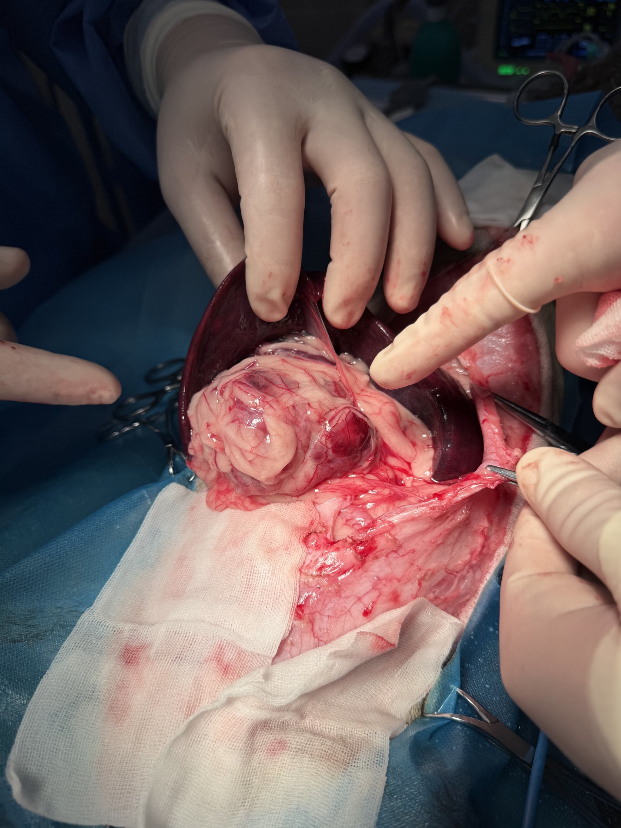 切除脾脏会活几年