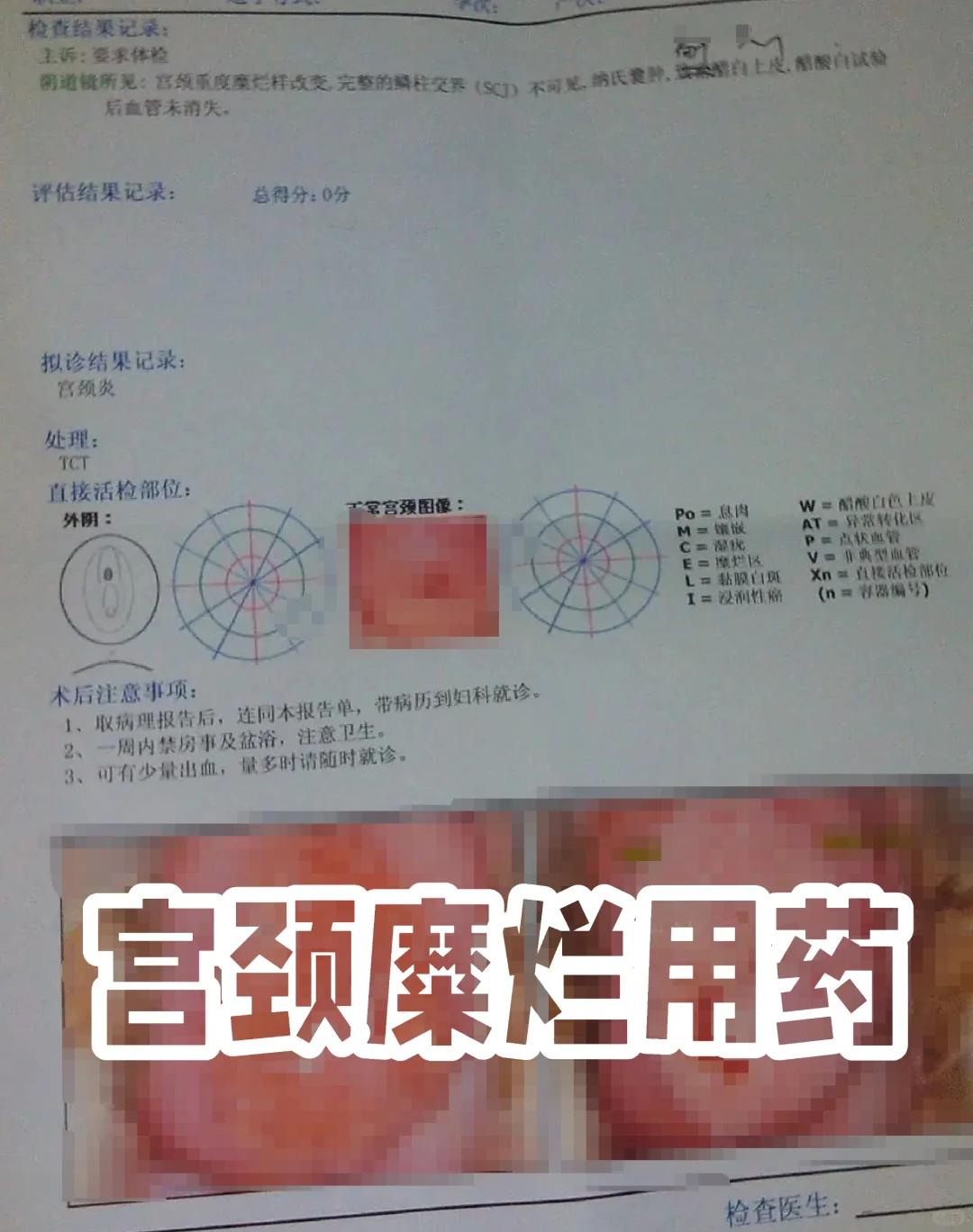 宫颈糜烂如何治