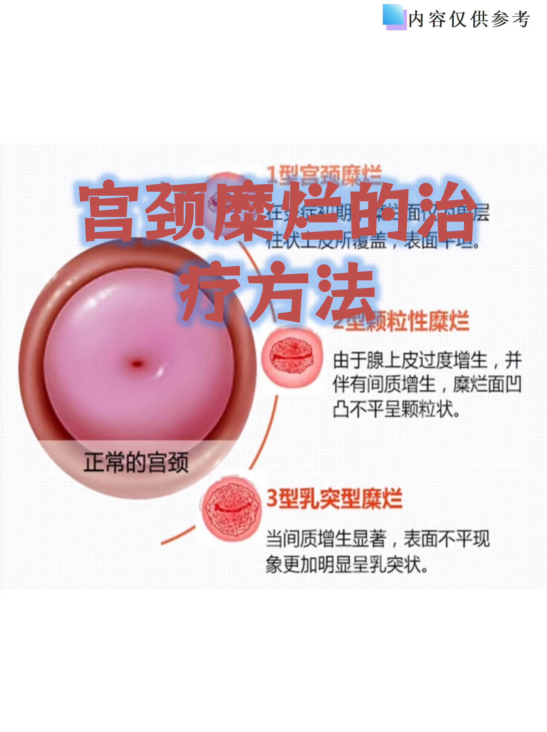 宫颈糜烂如何治