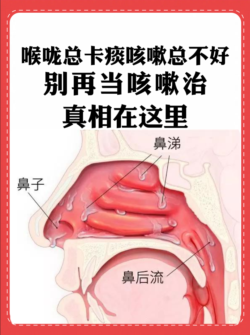 鼻中隔穿孔是怎么回事