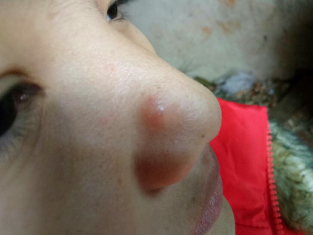 鼻子上有一个大包,,毛孔堵塞