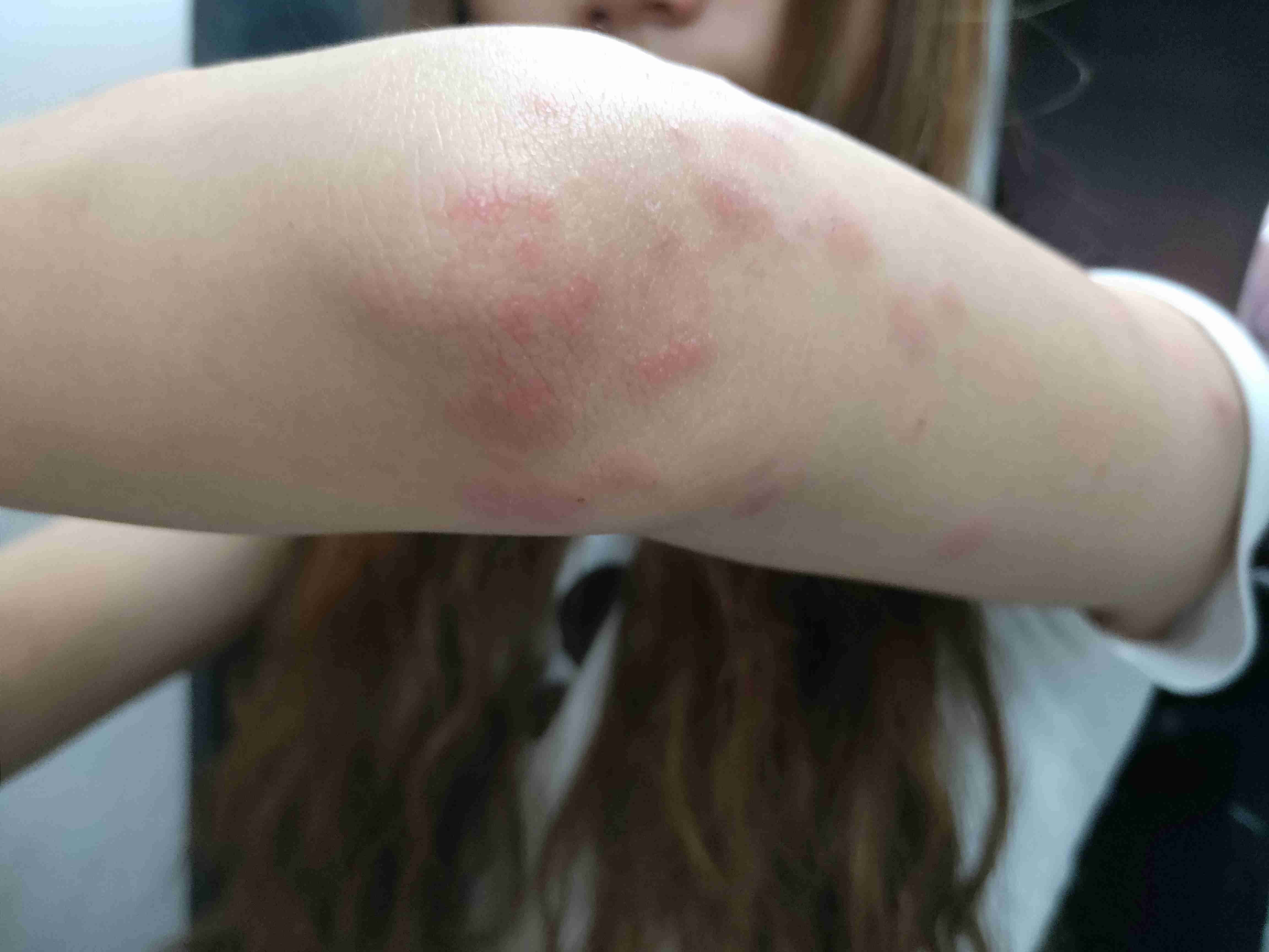 皮肤痒,一抓就起一片疙瘩