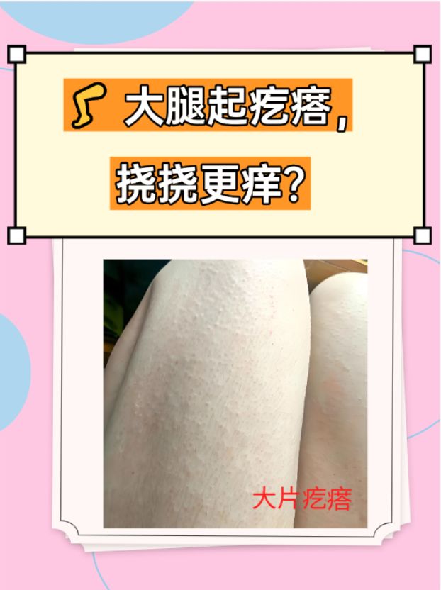 皮肤痒,一抓就起一片疙瘩