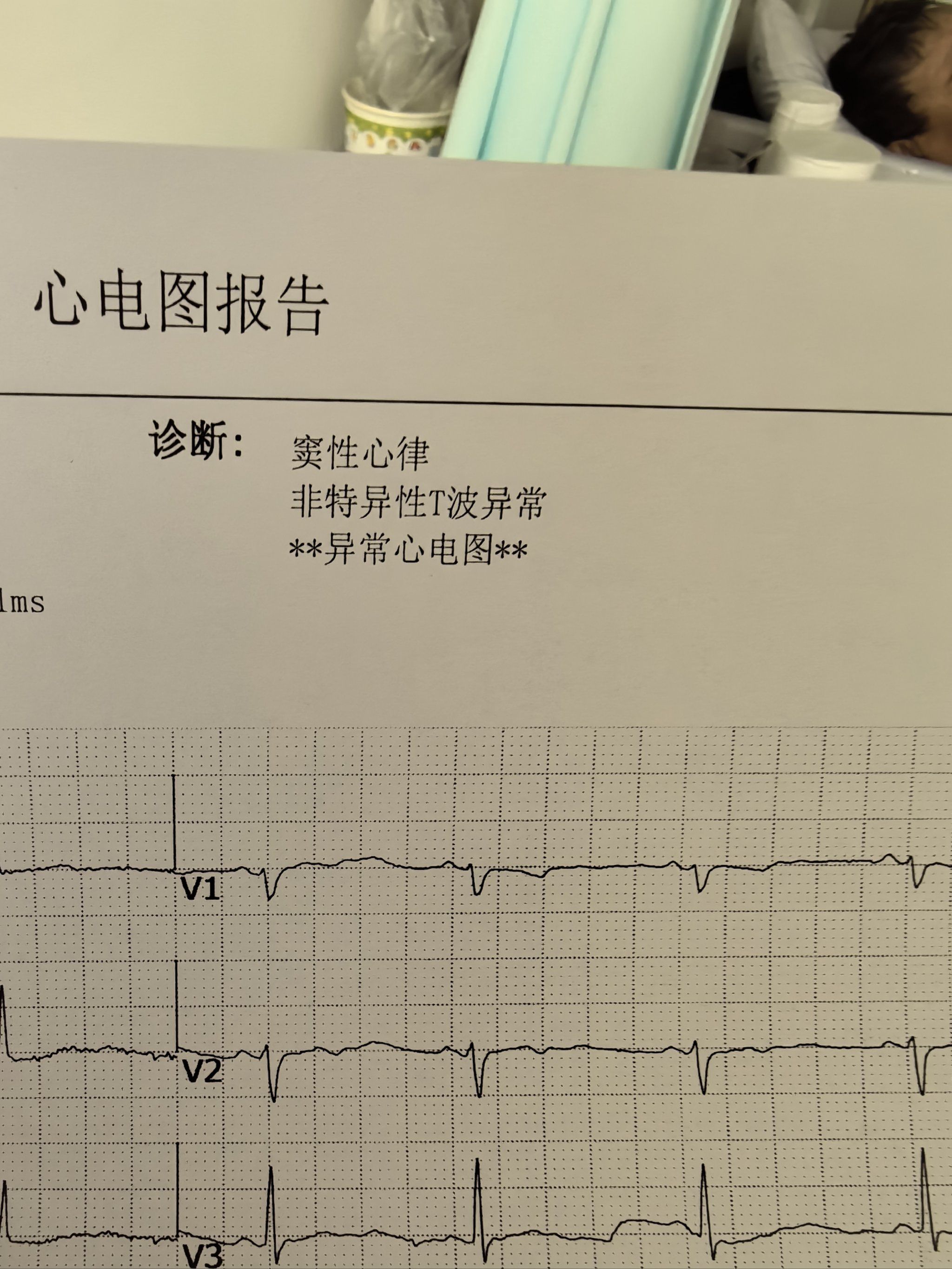 窦性心律,T波改变严重吗?