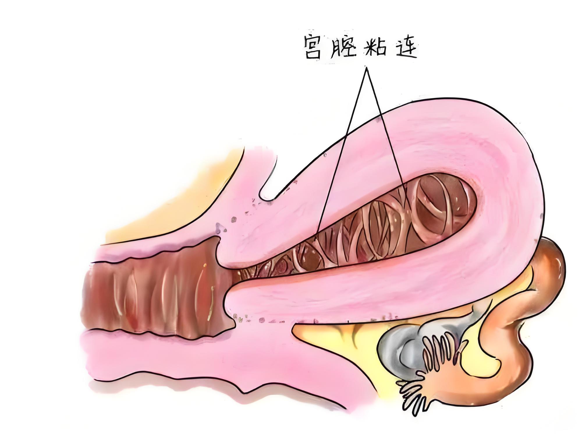 宫腔镜和清宫的区别