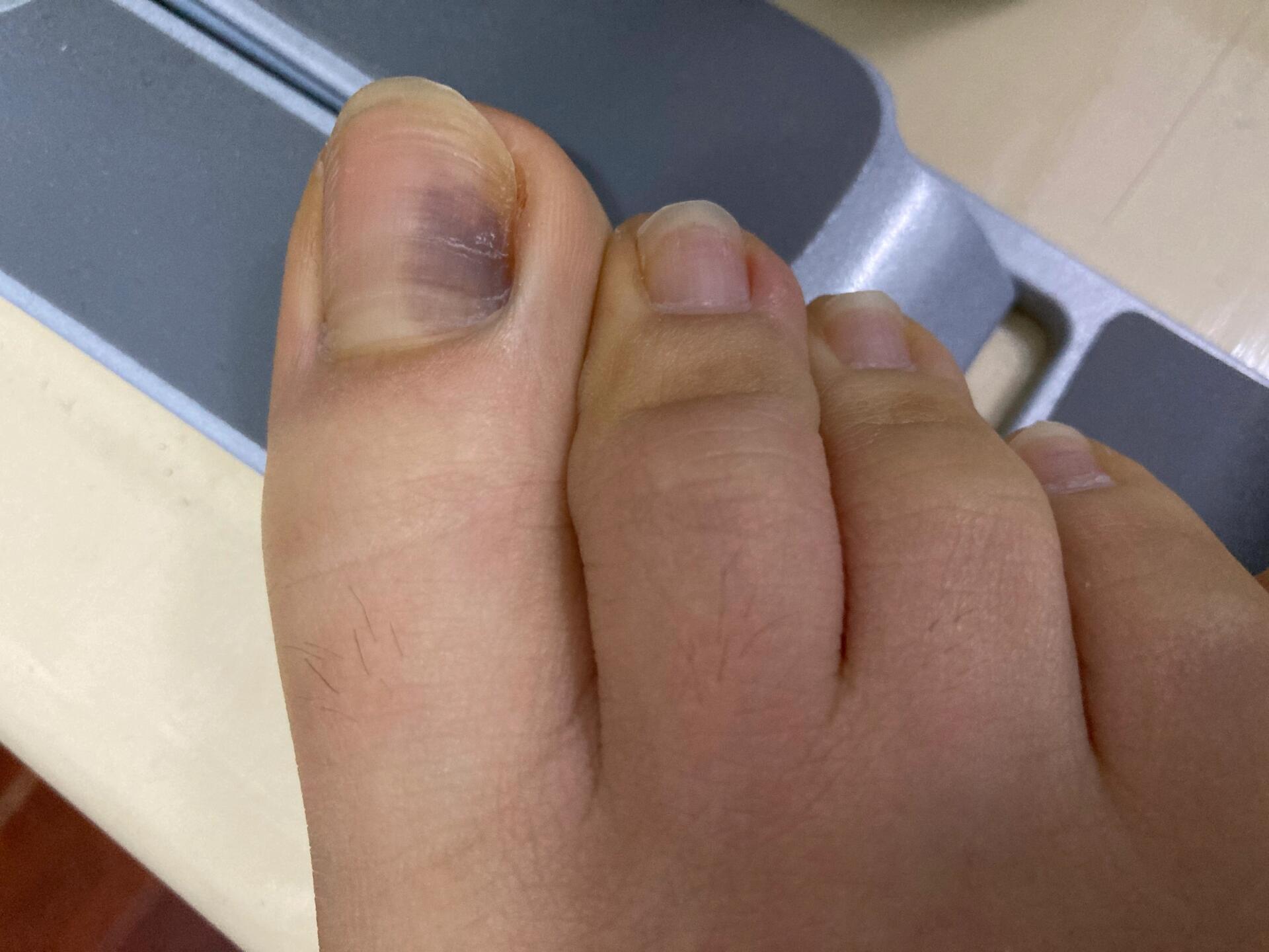 脚趾甲发黑,没有淤血,什么症状