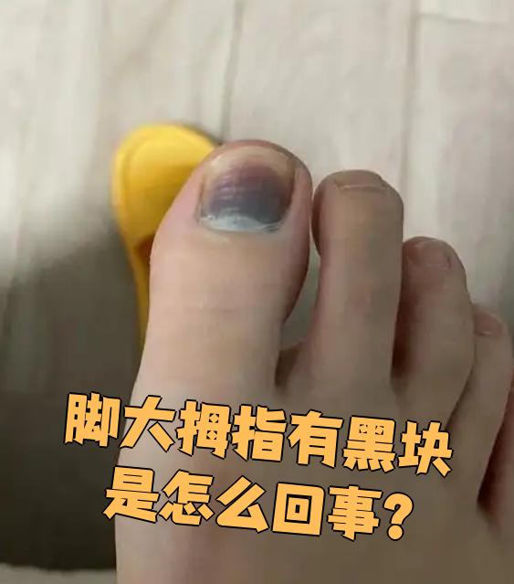 脚趾甲发黑,没有淤血,什么症状