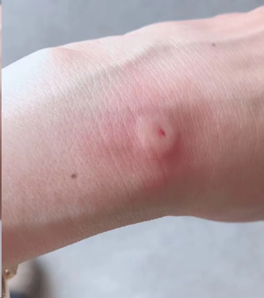 被蜜蜂蛰后肿多久