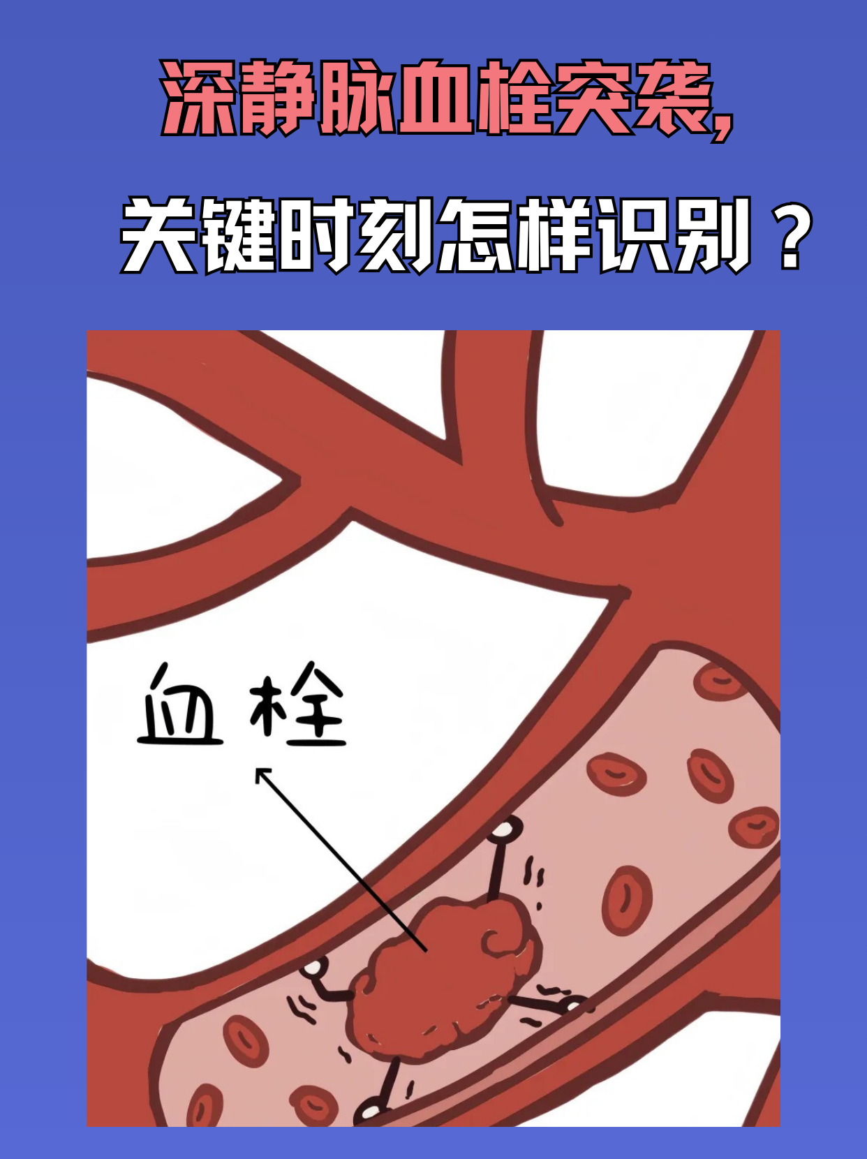 血栓性静脉炎是怎么回事