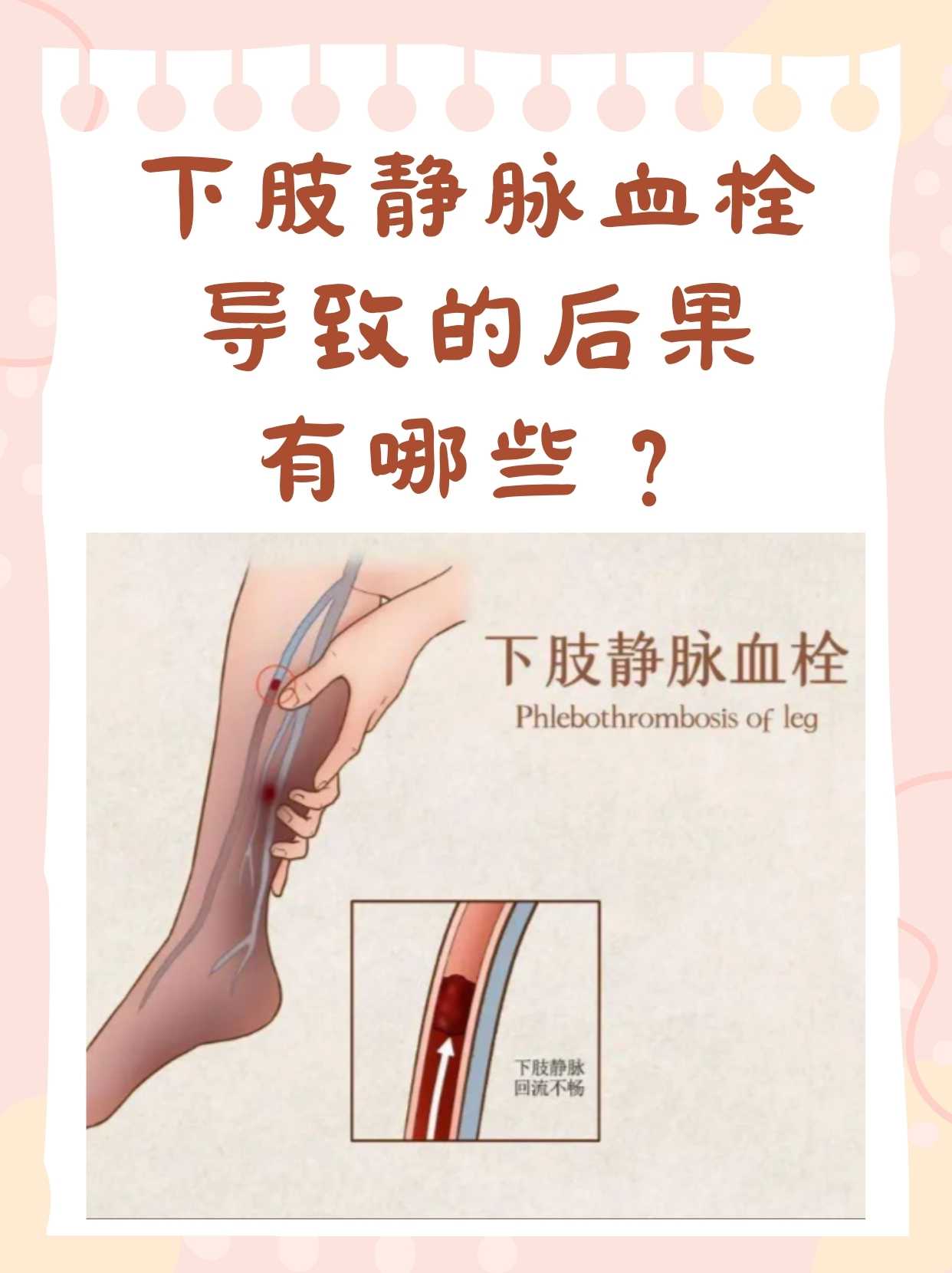 血栓性静脉炎是怎么回事