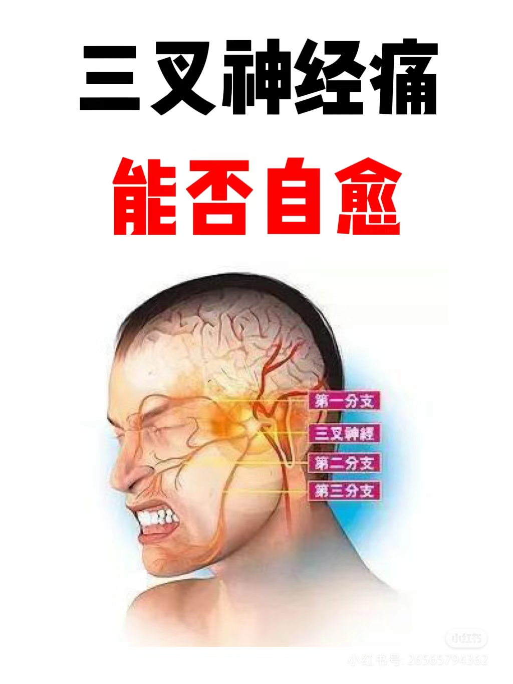 三叉神经痛会自愈吗