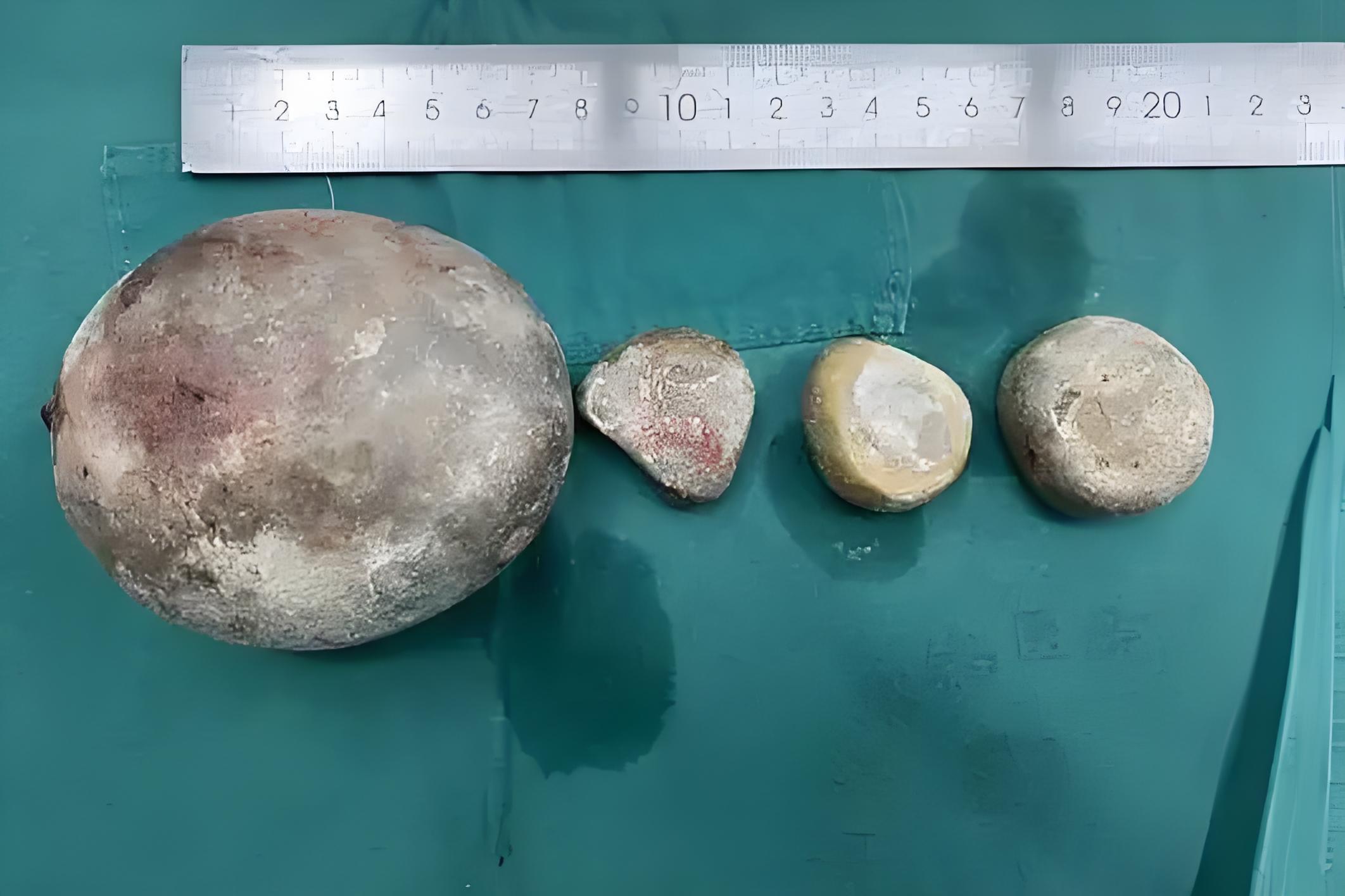 泌尿系结石是什么