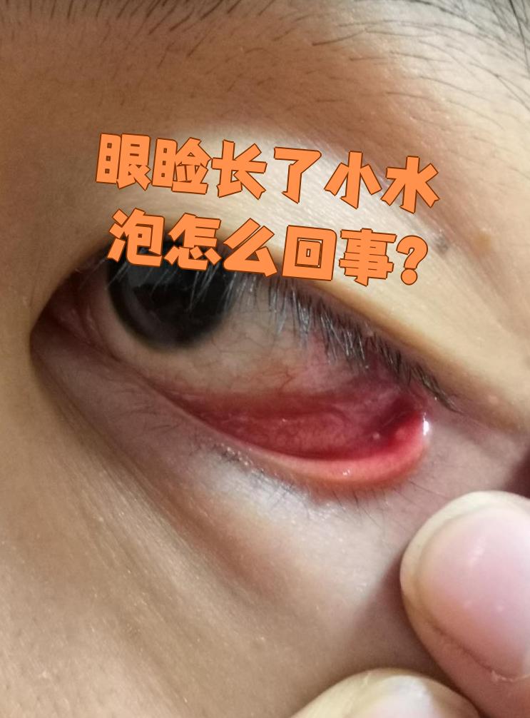 眼皮底下长疙瘩