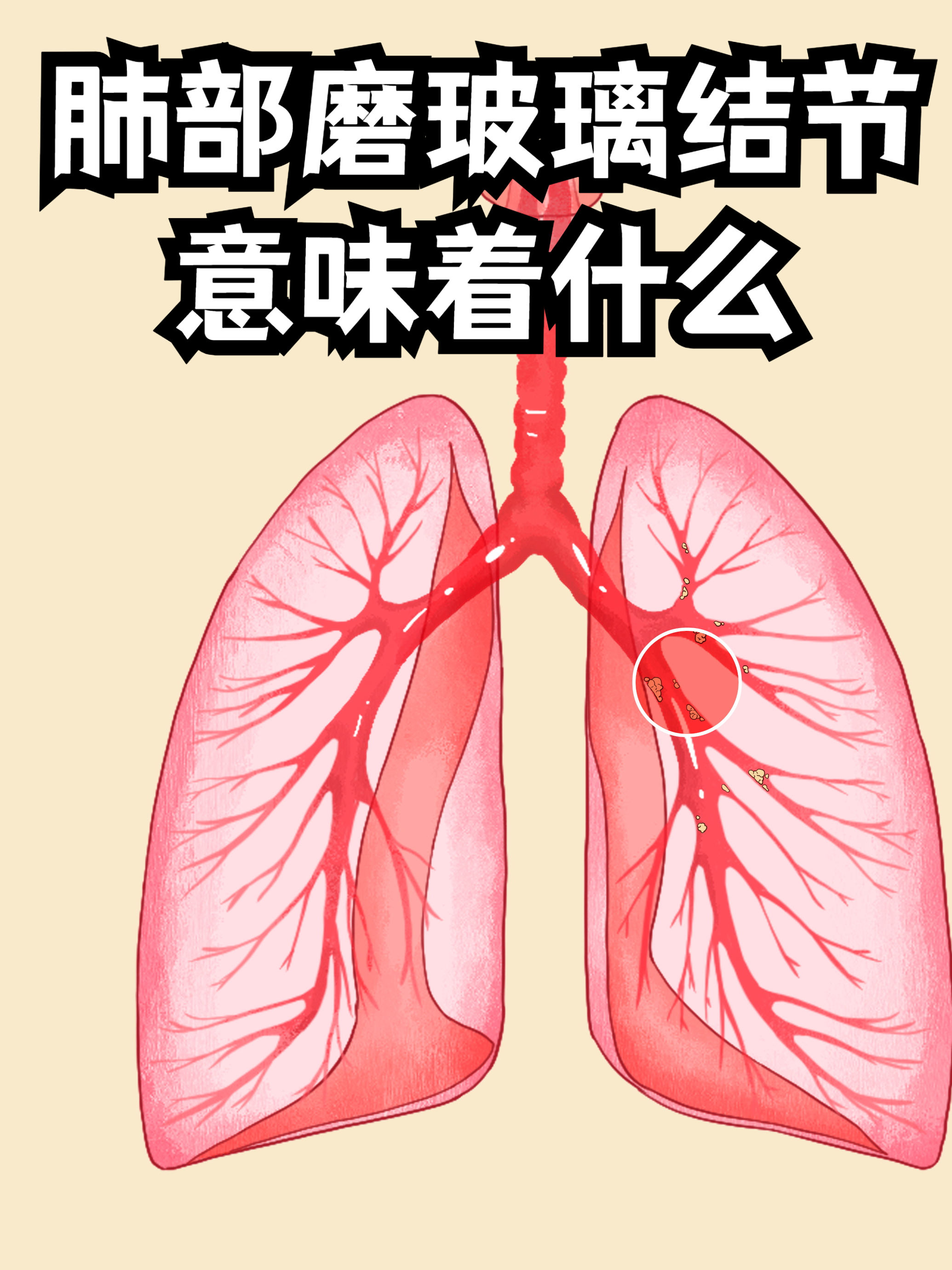 支气管癌早期的症状有什么