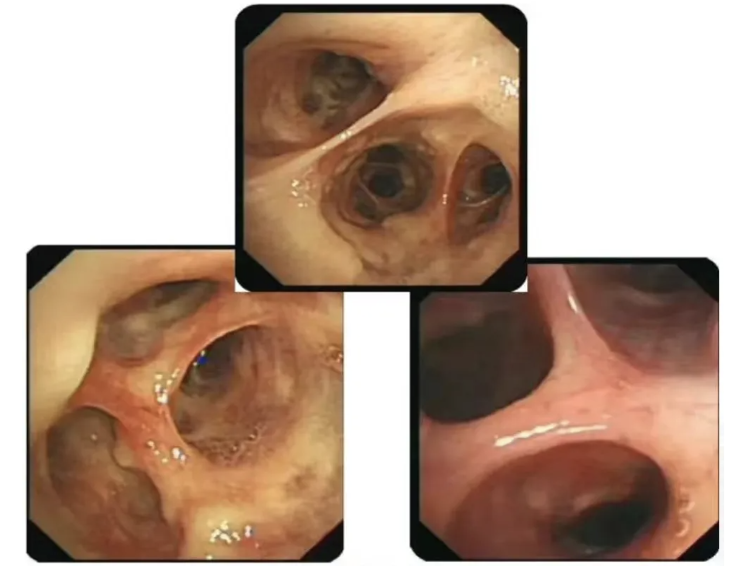 支气管癌早期的症状有什么