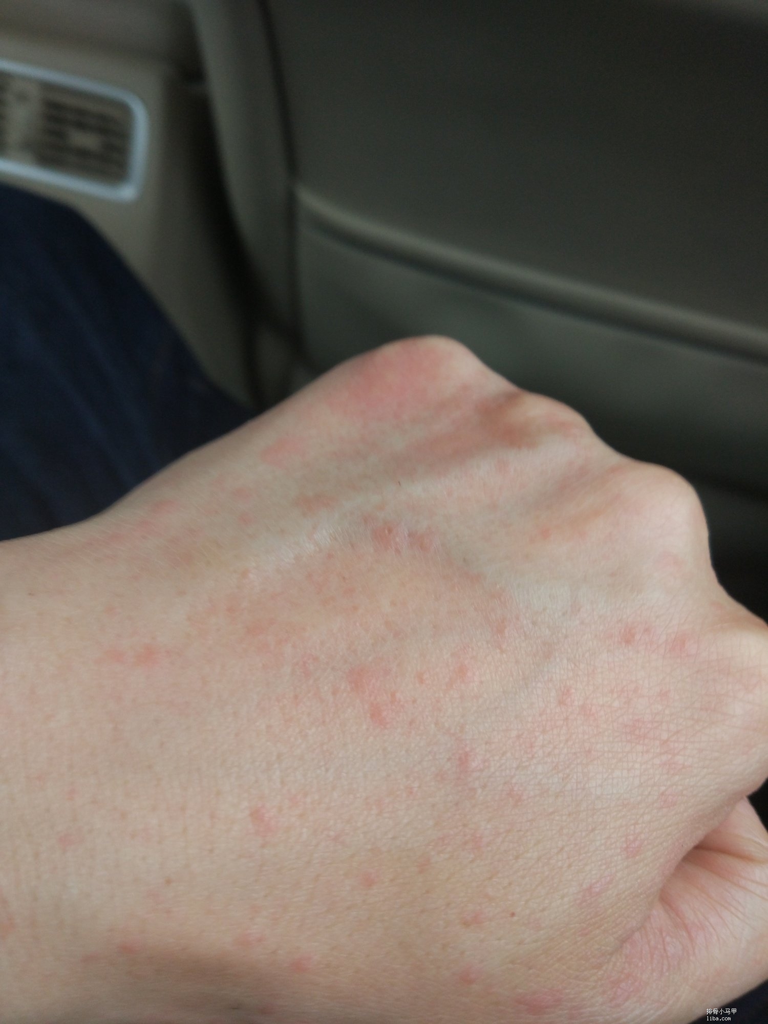 手上起红点,很痒怎么回事?