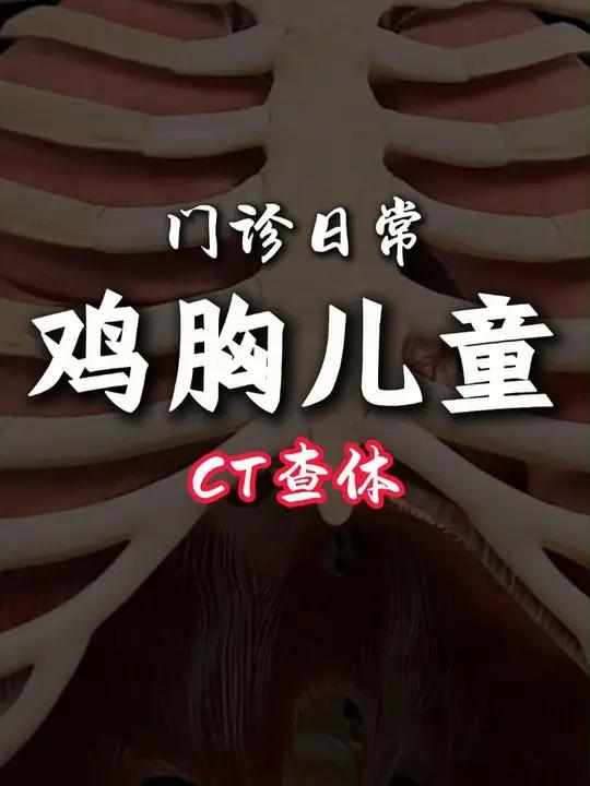 小儿鸡胸的表现有哪些