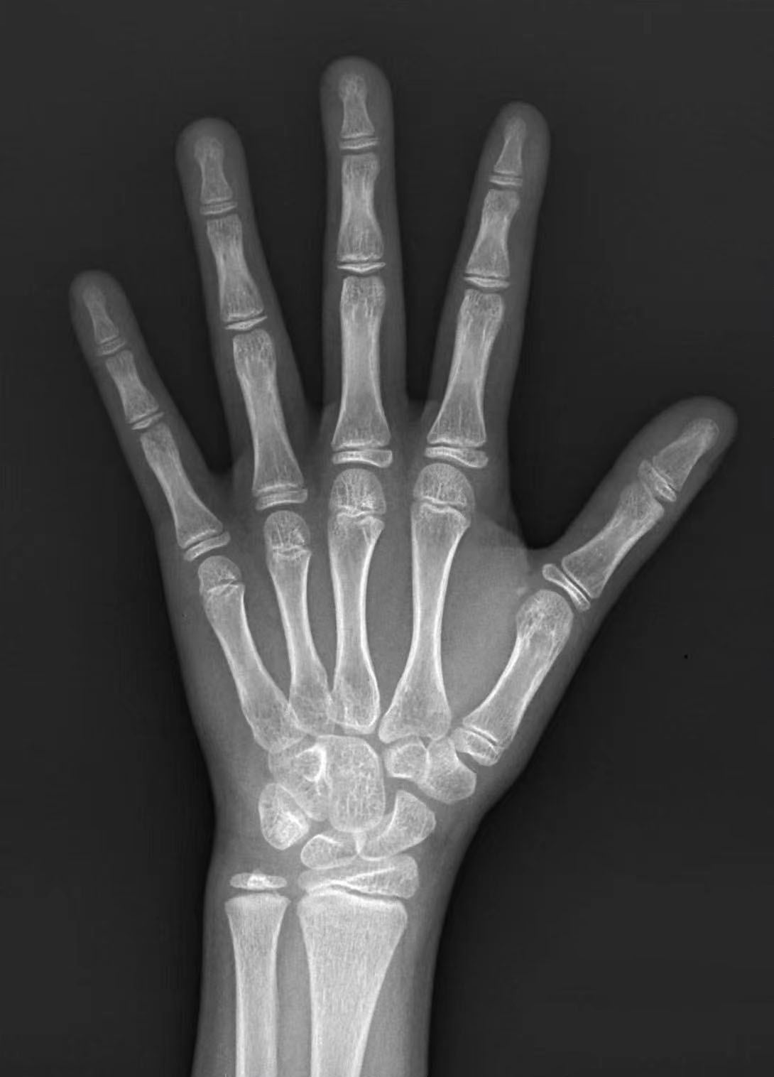 骨龄闭合还能长高吗