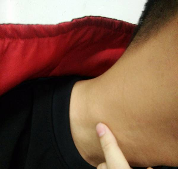 脖子右侧长个疙瘩,不疼