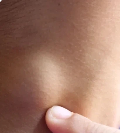 脖子右侧长个疙瘩,不疼