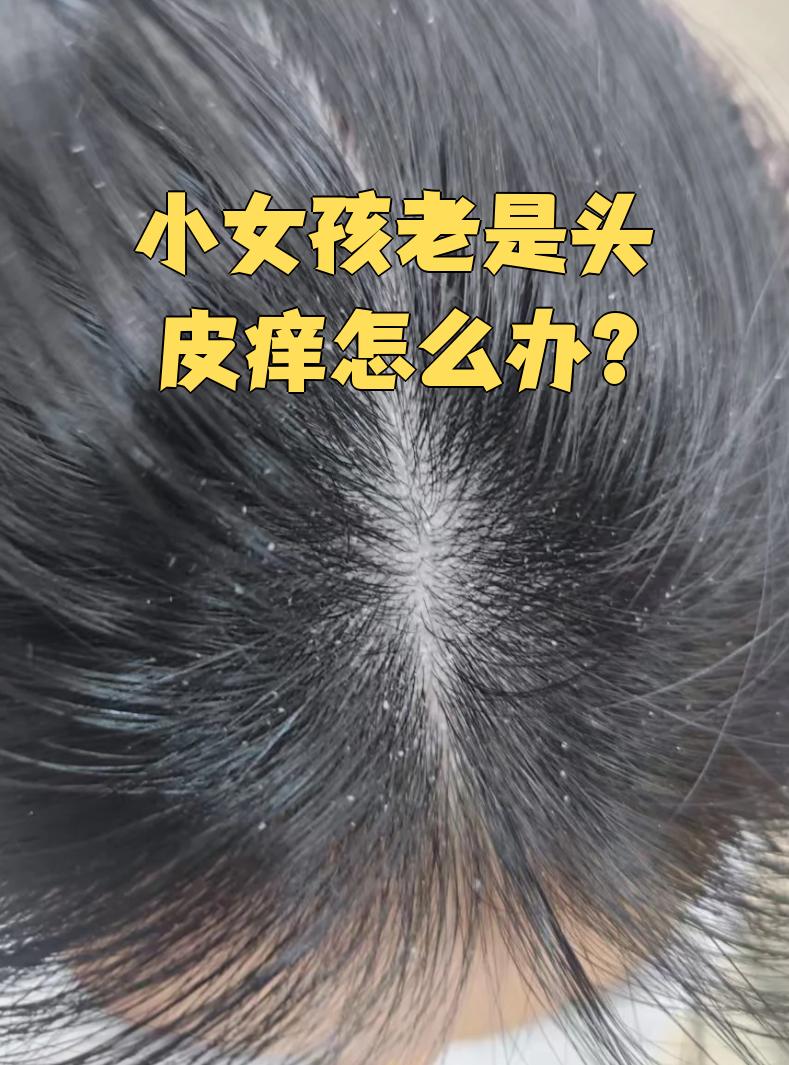 为什么洗了头还是痒