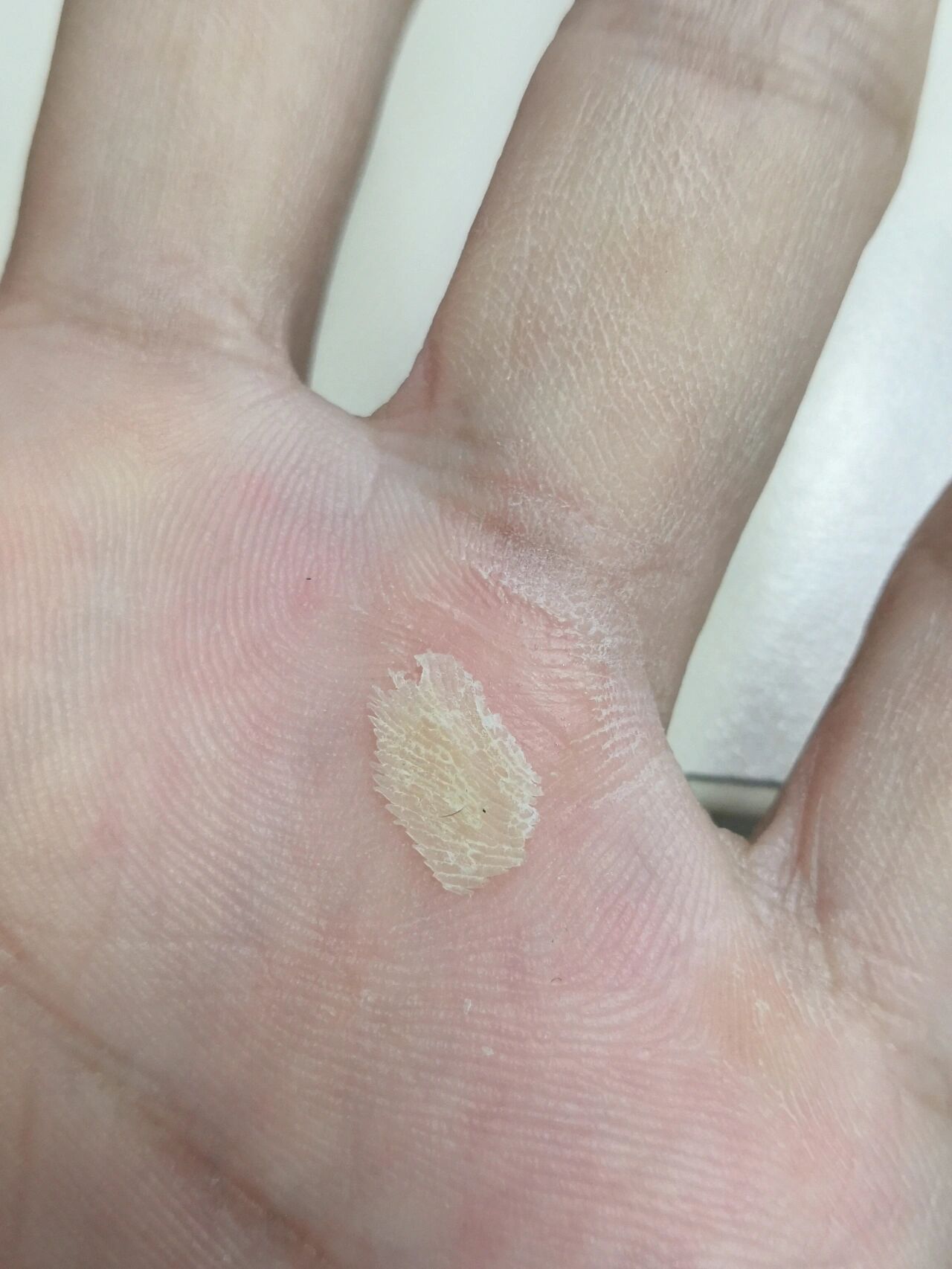 手上长了像茧子一样的东西