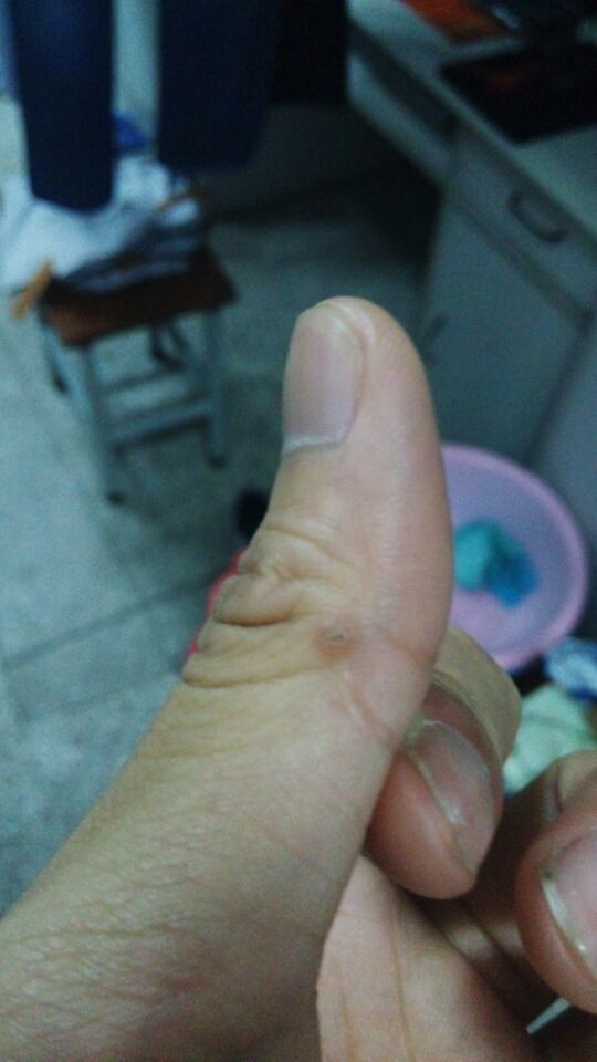 手上长了像茧子一样的东西