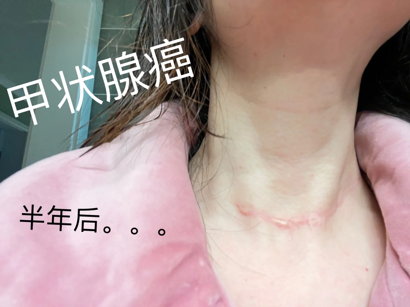 甲状腺癌手术后能活多久