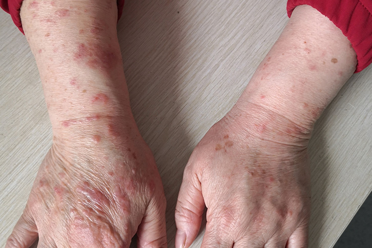 湿疹的症状是什么